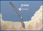Proximal Anterior Strips 1.387A (12 pcs.)