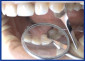 Proximal Anterior Strips 1.387A (12 pcs.)
