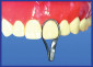 Twin Anterior Matrices 1.523 (12 pcs.)