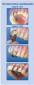 Twin Anterior Matrices 1.533 (12 pcs.)